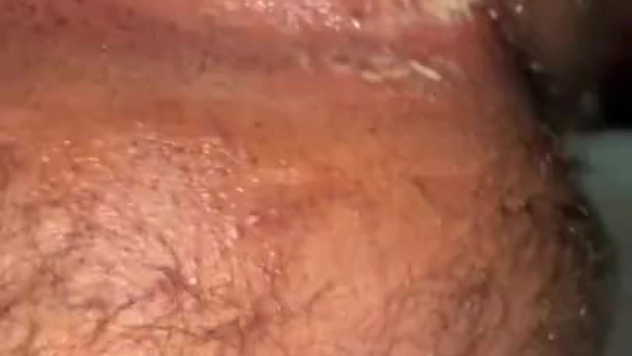Gay Fisting Leads to Anal Prolapse